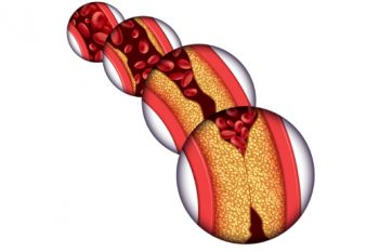 ¿Qué es una cardiopatía?